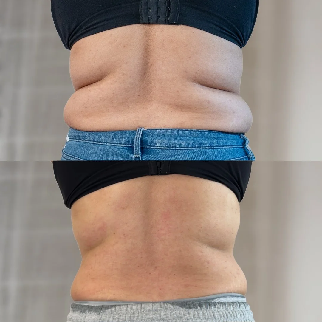 Back and Bra Roll Reduction before and after 3 treatments