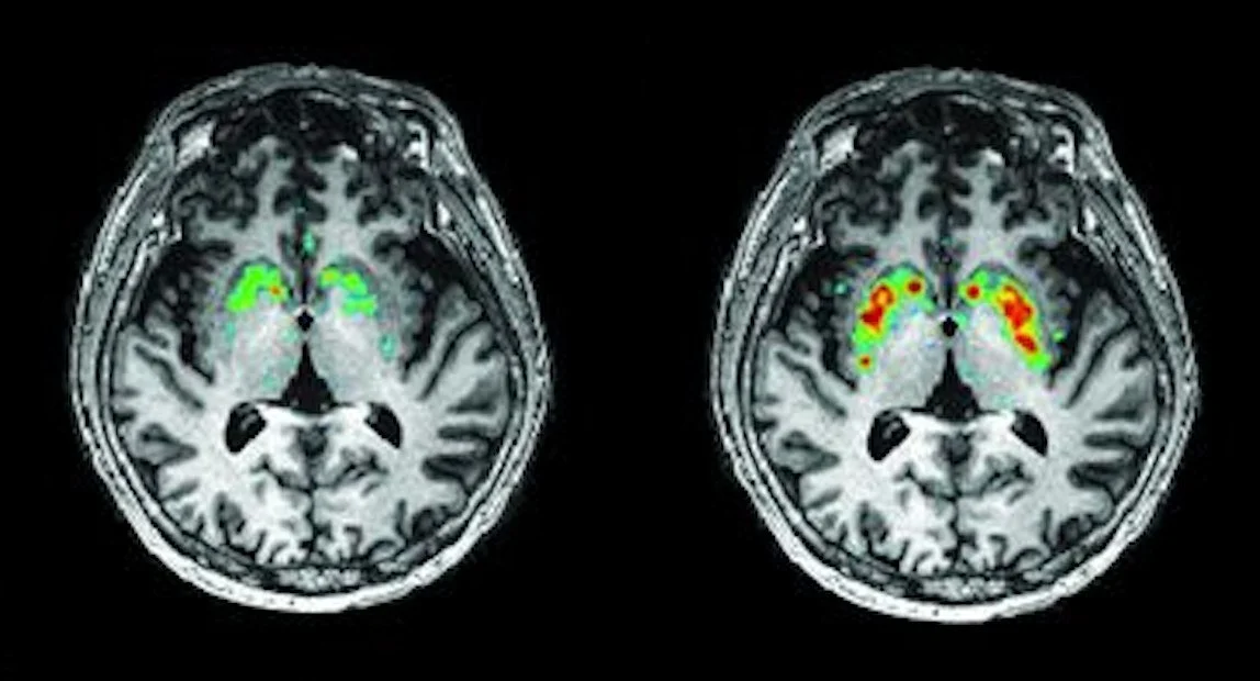PET scans showing the putamen before and after gene therapy for Parkinson’s disease. From Richardson et al., 2022.