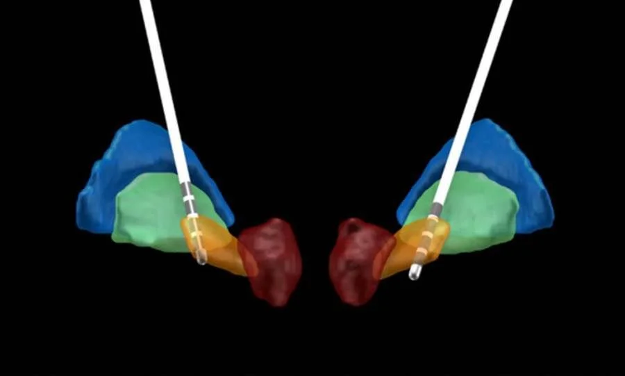 DBS lead reconstruction. Using special software, the post-operative CT is combined with the pre-operative MRI to generate an estimation of the lead locations within the target structure, for each patient. Here, the contacts of bilateral DBS leads are shown within the subthalamic nucleus (orange volume).