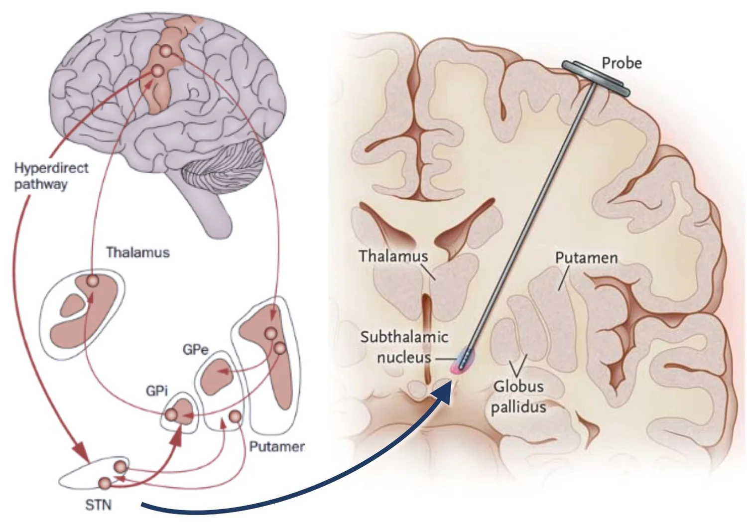 Basal ganglia-thalamus-cortex loop circuit. The left drawing shows the motor control circuit including the basal ganglia nodes STN and GPi. The right drawing shows a DBS lead implanted in the STN.