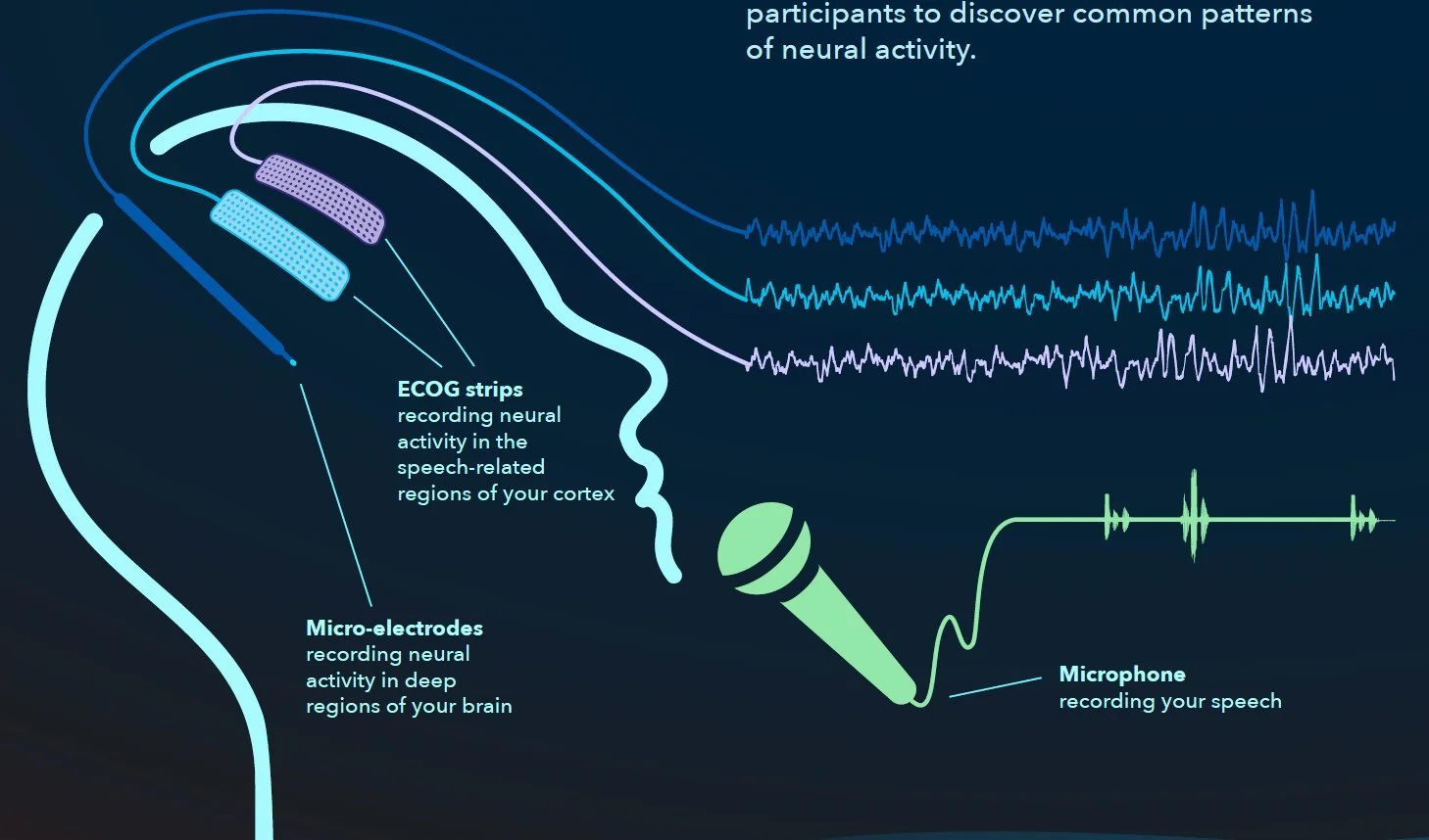 Recording speech-related brain activity. Electrodes record from the cortex and from the DBS target at the same time while patients perform speech tasks during surgery.