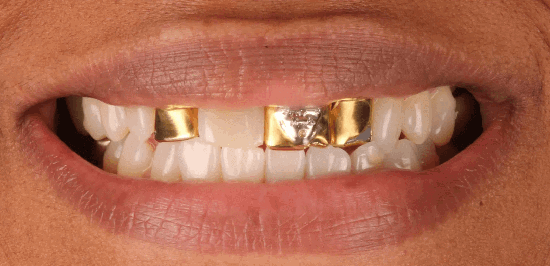 Replace Metal Crowns