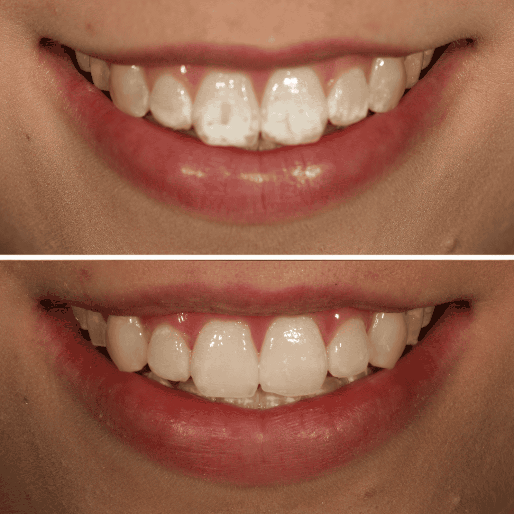 White Spots Treatment