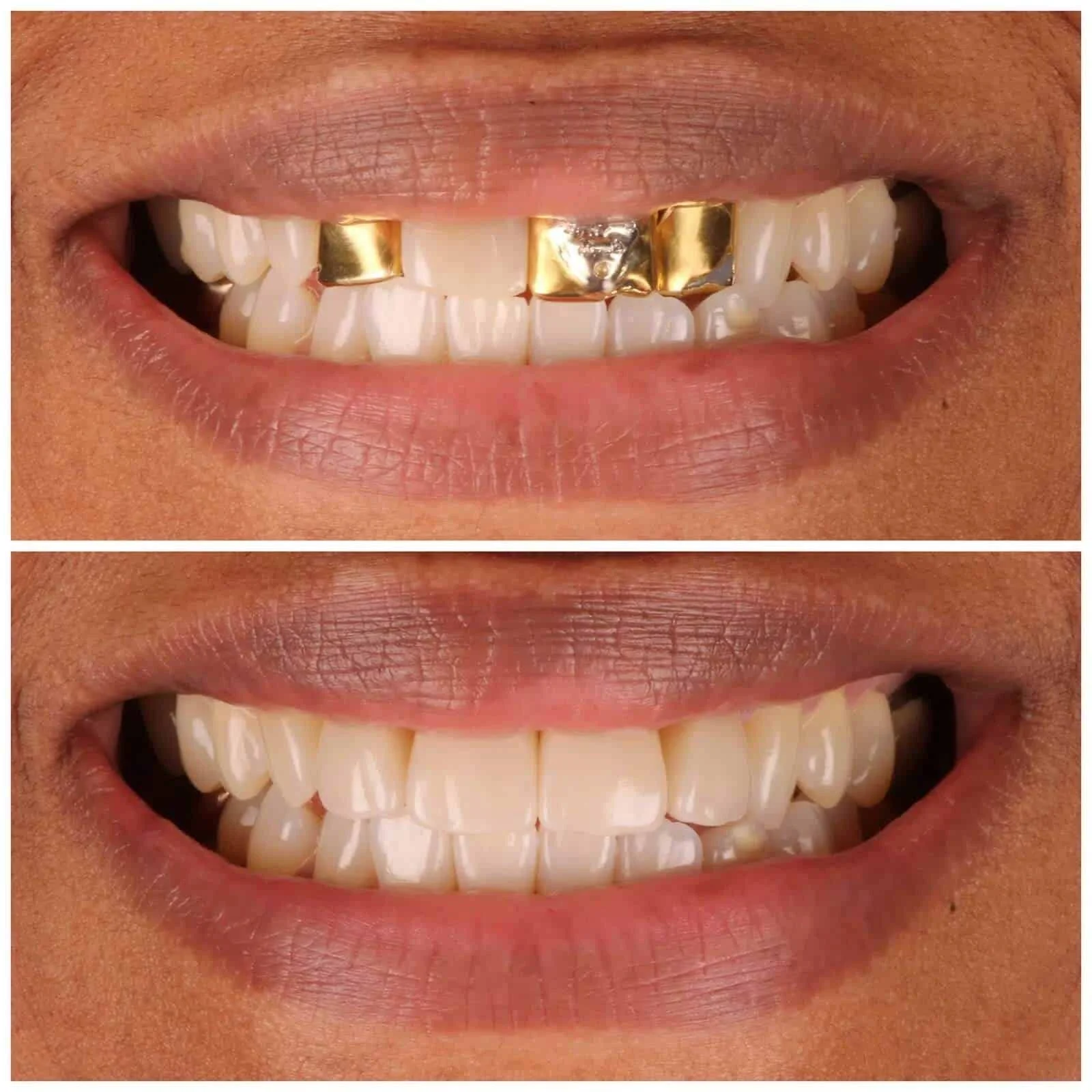 Replace Metal Veneers and Crowns