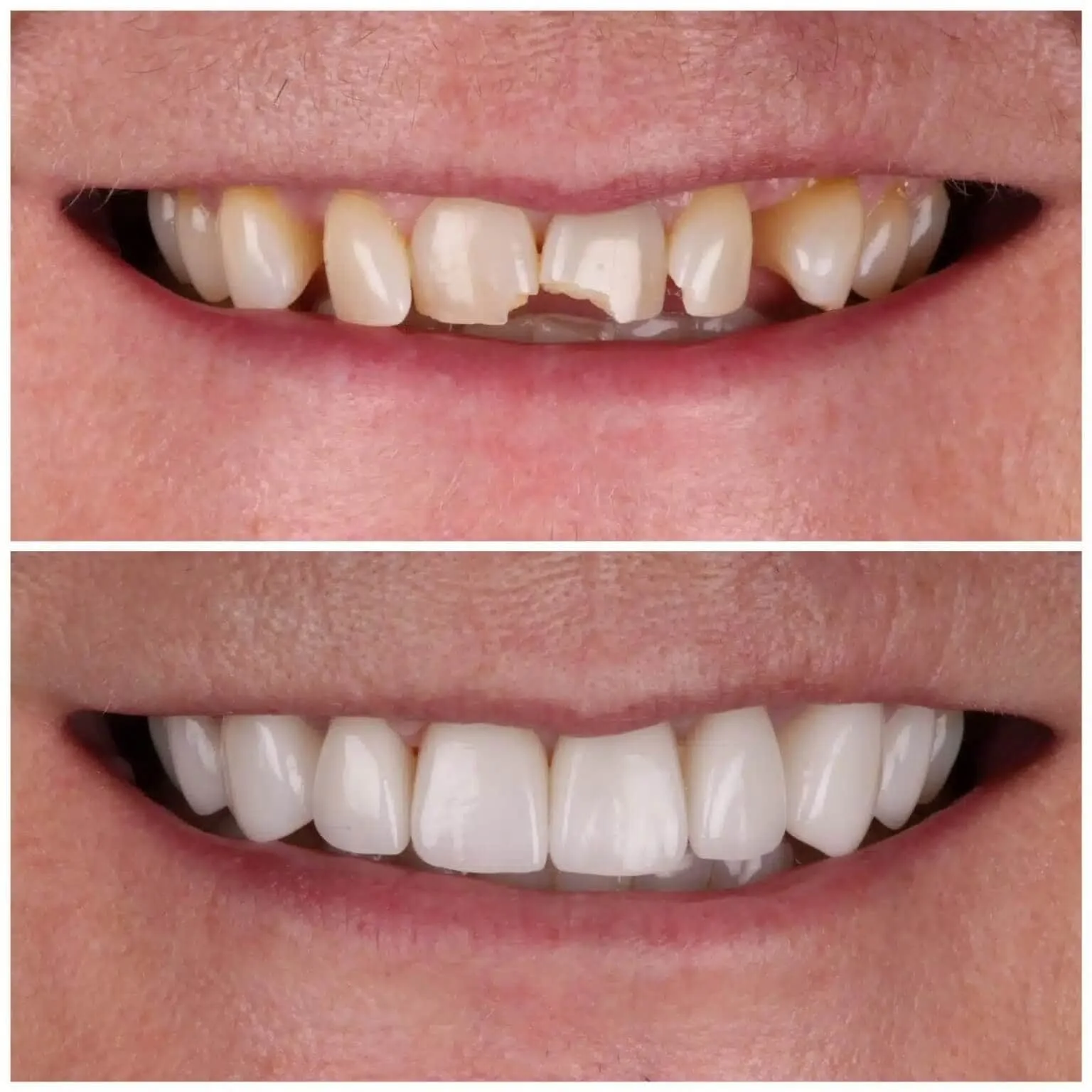 Chipped or Broken Teeth