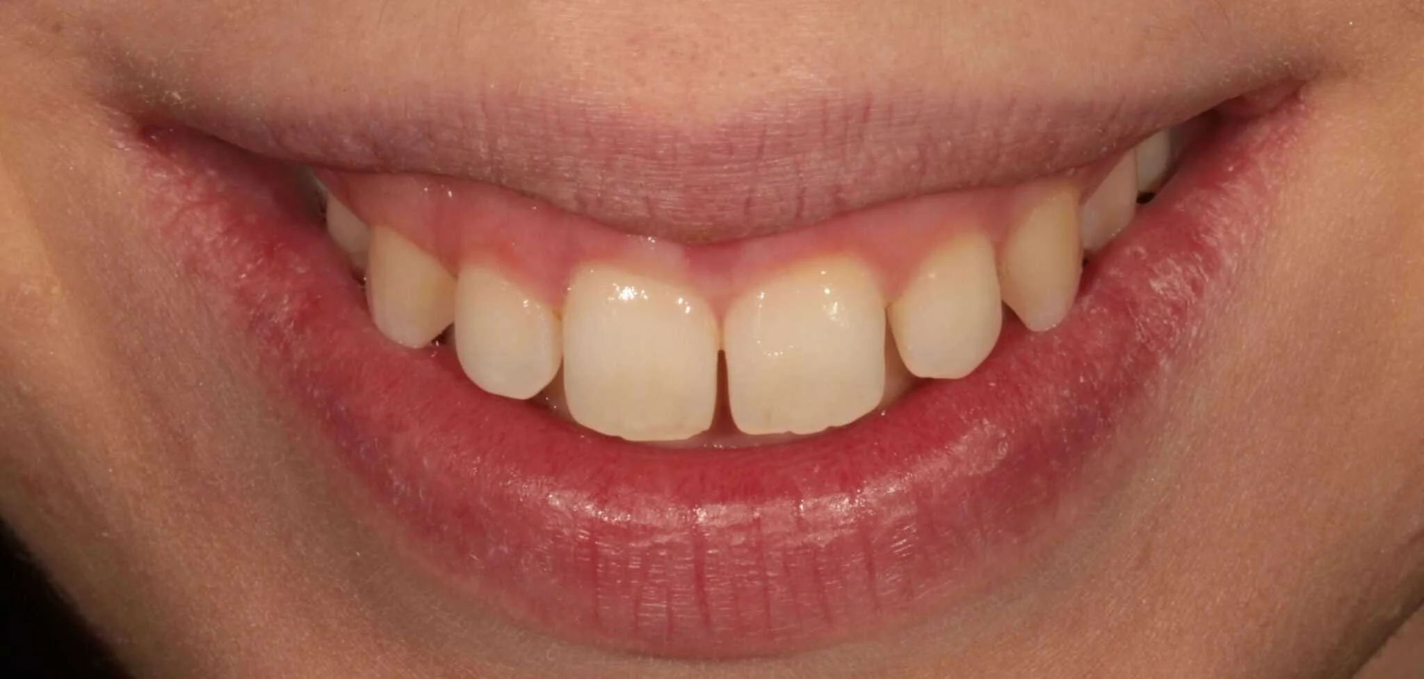 Tooth Discolouration Treatment