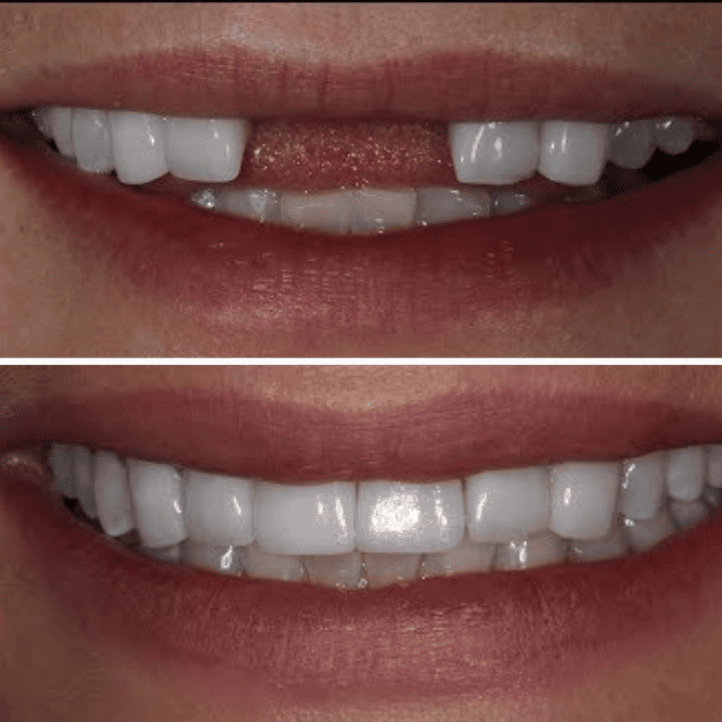 Missing Teeth Treatment