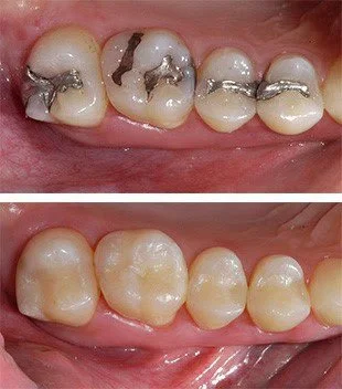 Replace Metal Fillings Treatment