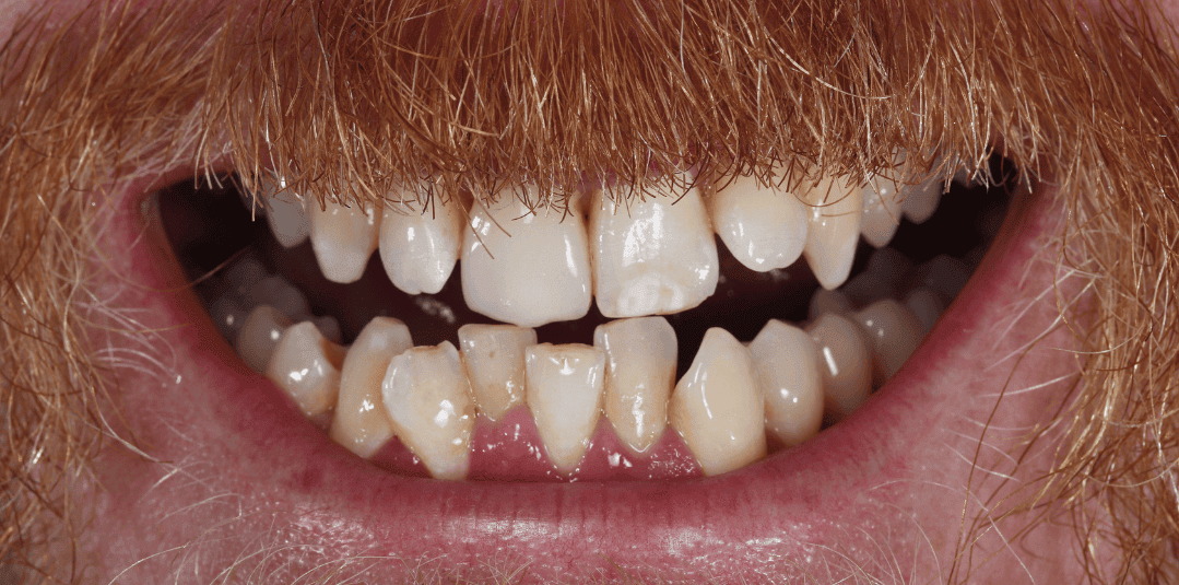 Misaligned and Crowded Teeth Treatment
