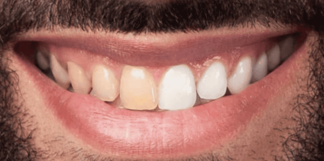 Tooth Discolouration