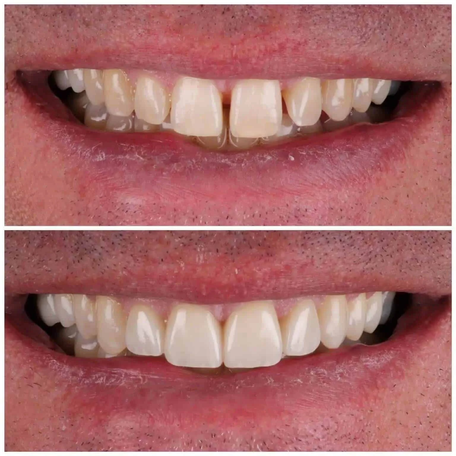 Gaps Between Teeth