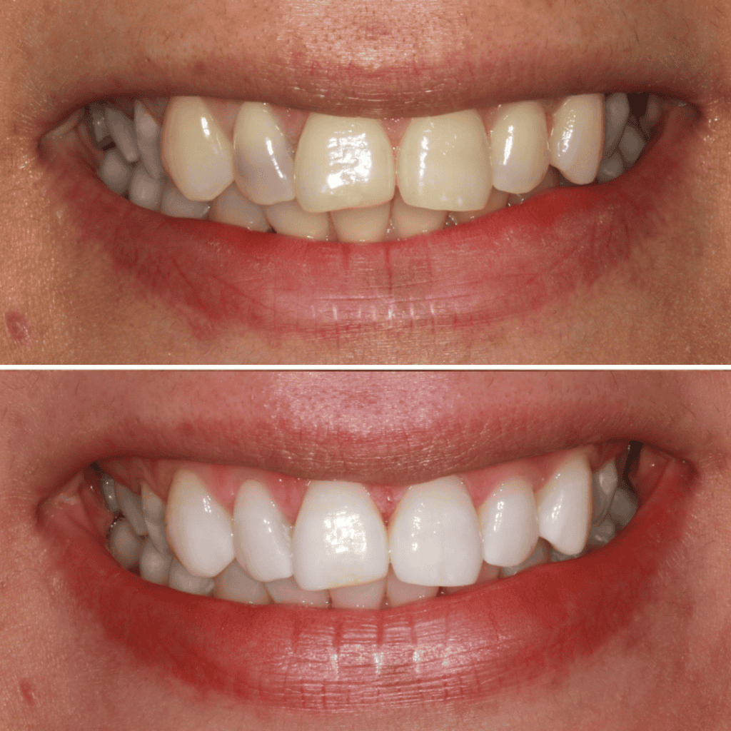 Misaligned or Crowded Teeth