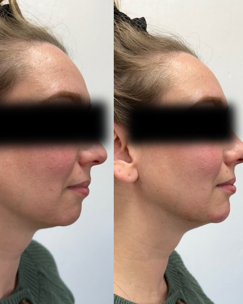 Jawline filler before and after