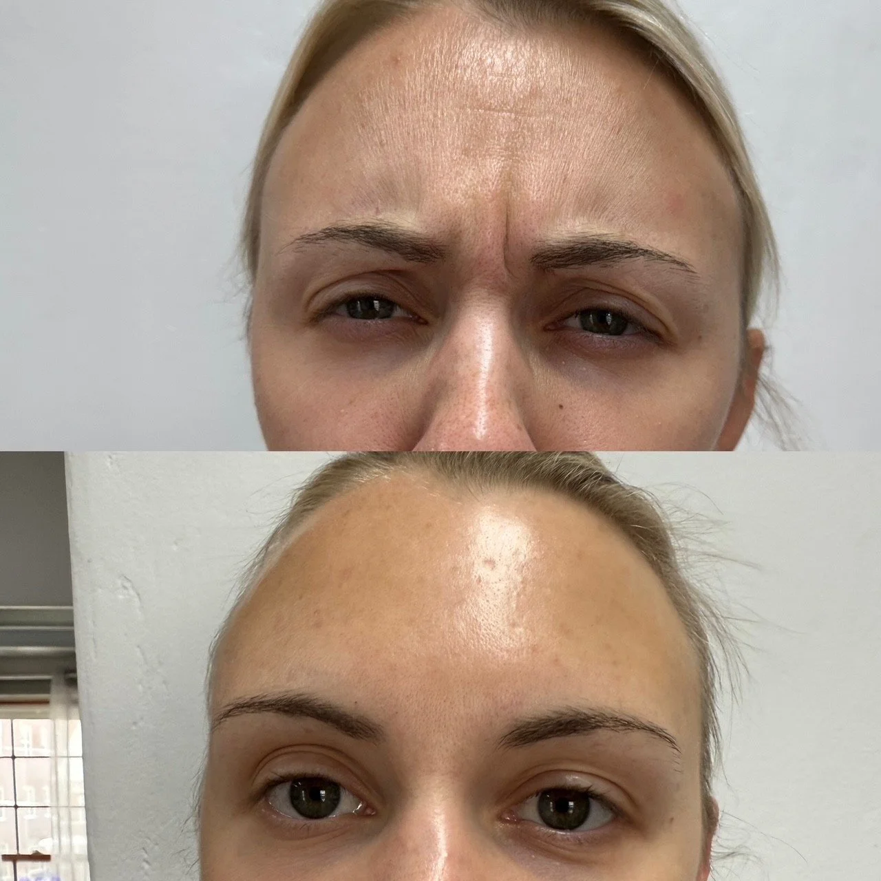 Forehead Botox treatment