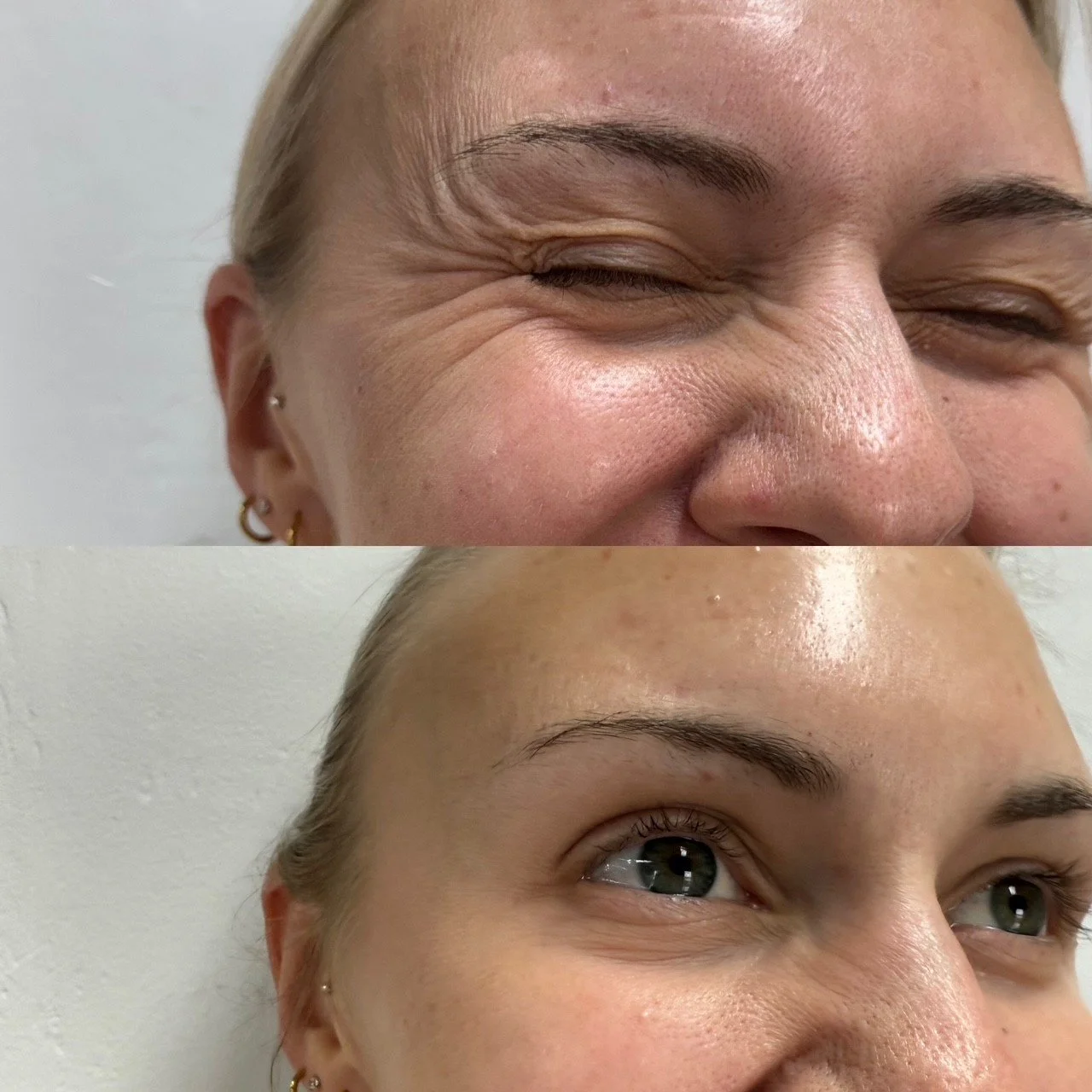 Crow's feet Botox treatment