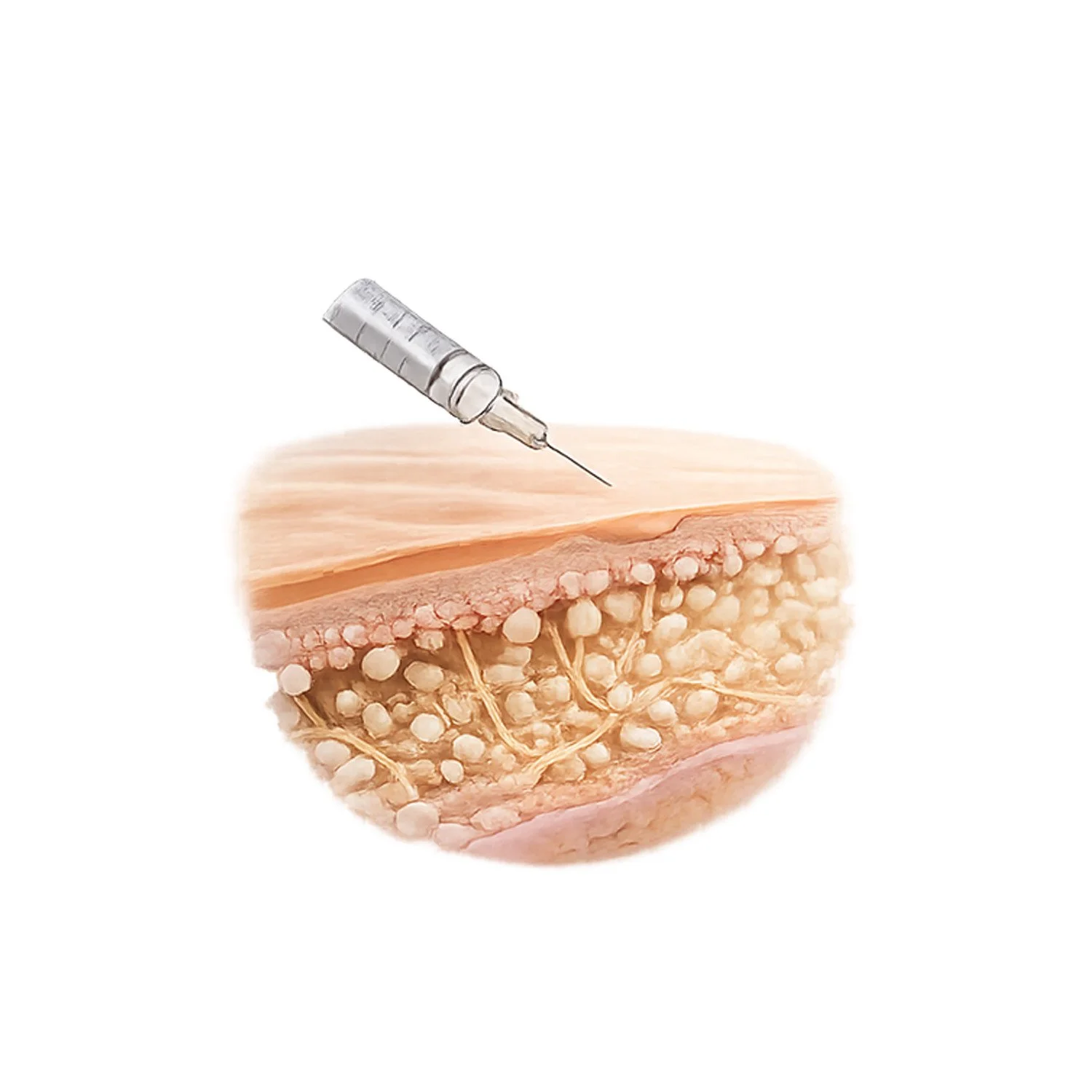 Sculptra stimulates collagen