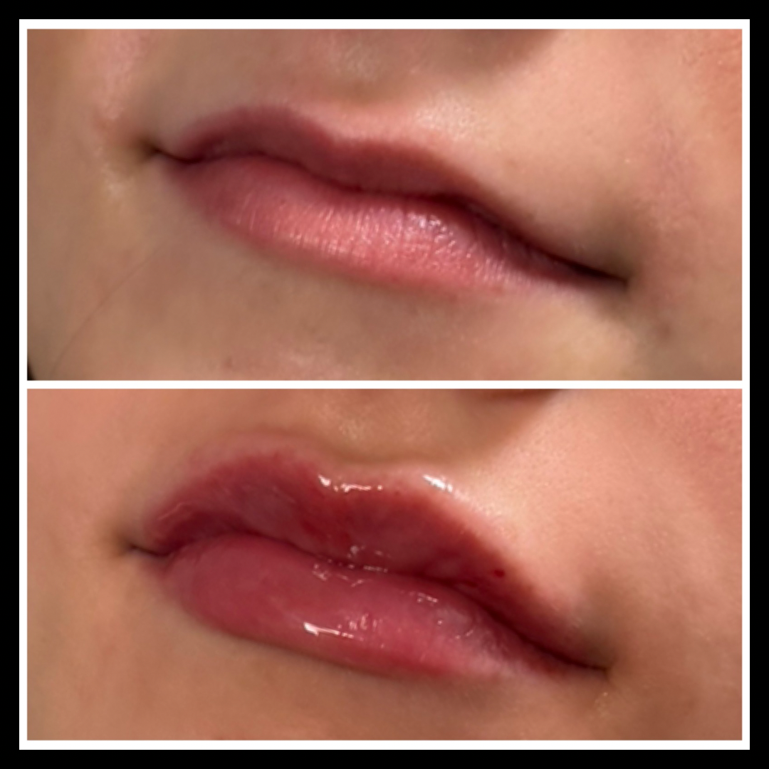 Lip filler before and after