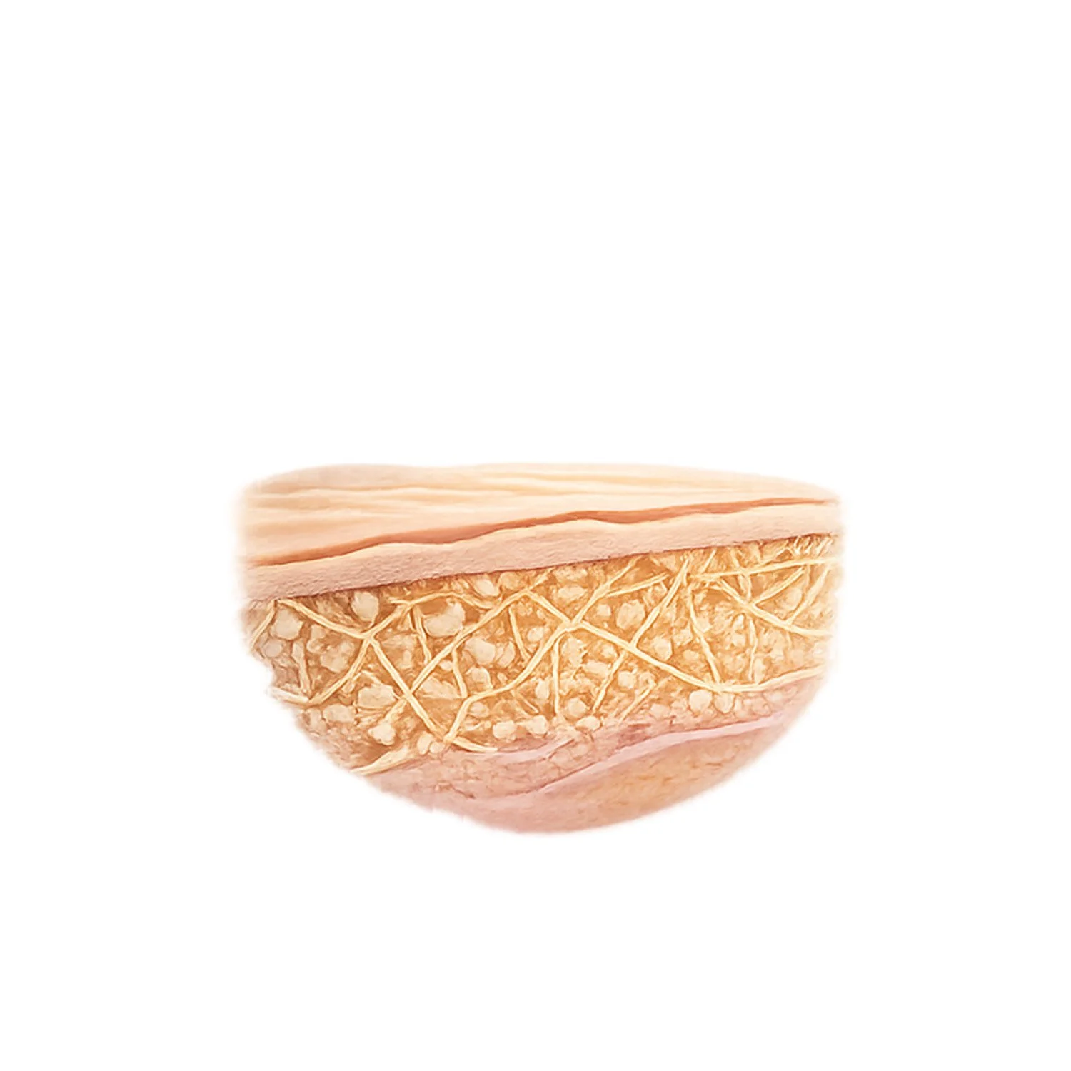 Gradual restoration from Sculptra