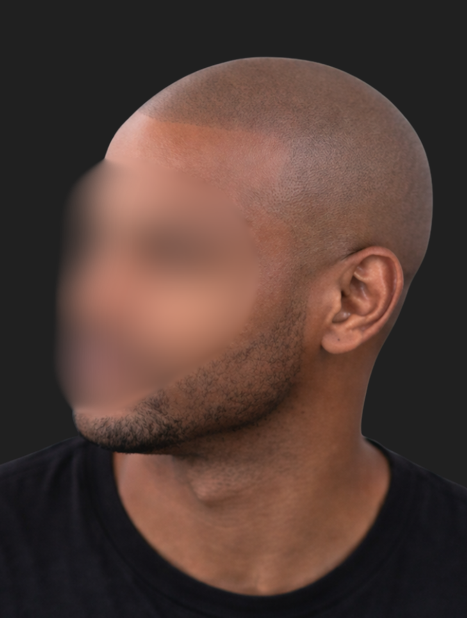 Bald man in image 4 before receiving hairline and visual density from Subtle Return.