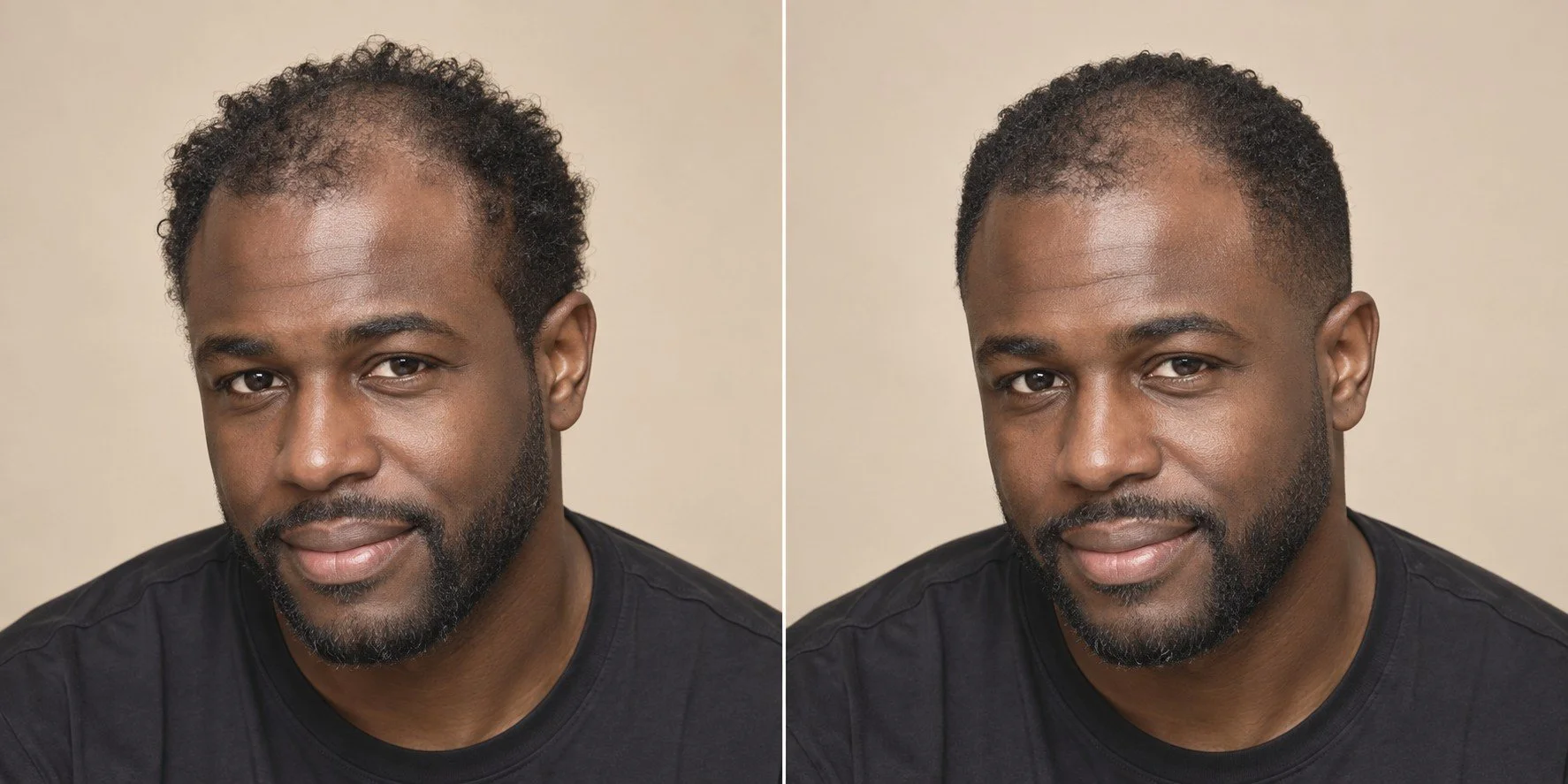 AI visualization of a Black man with diffuse thinning and naturally coily hair before and after a close textured crop