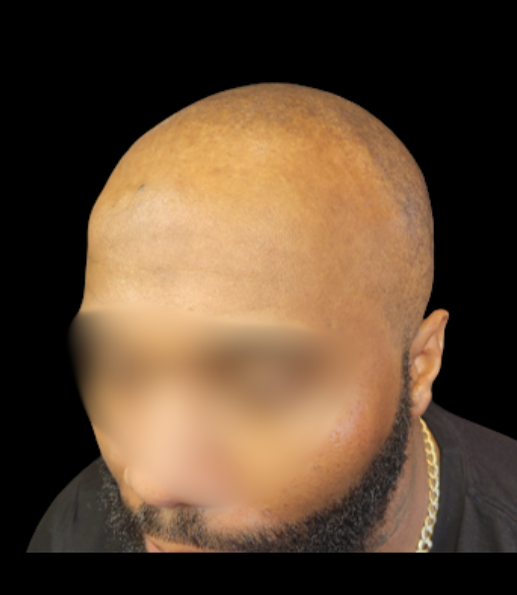 After treatment result example 1