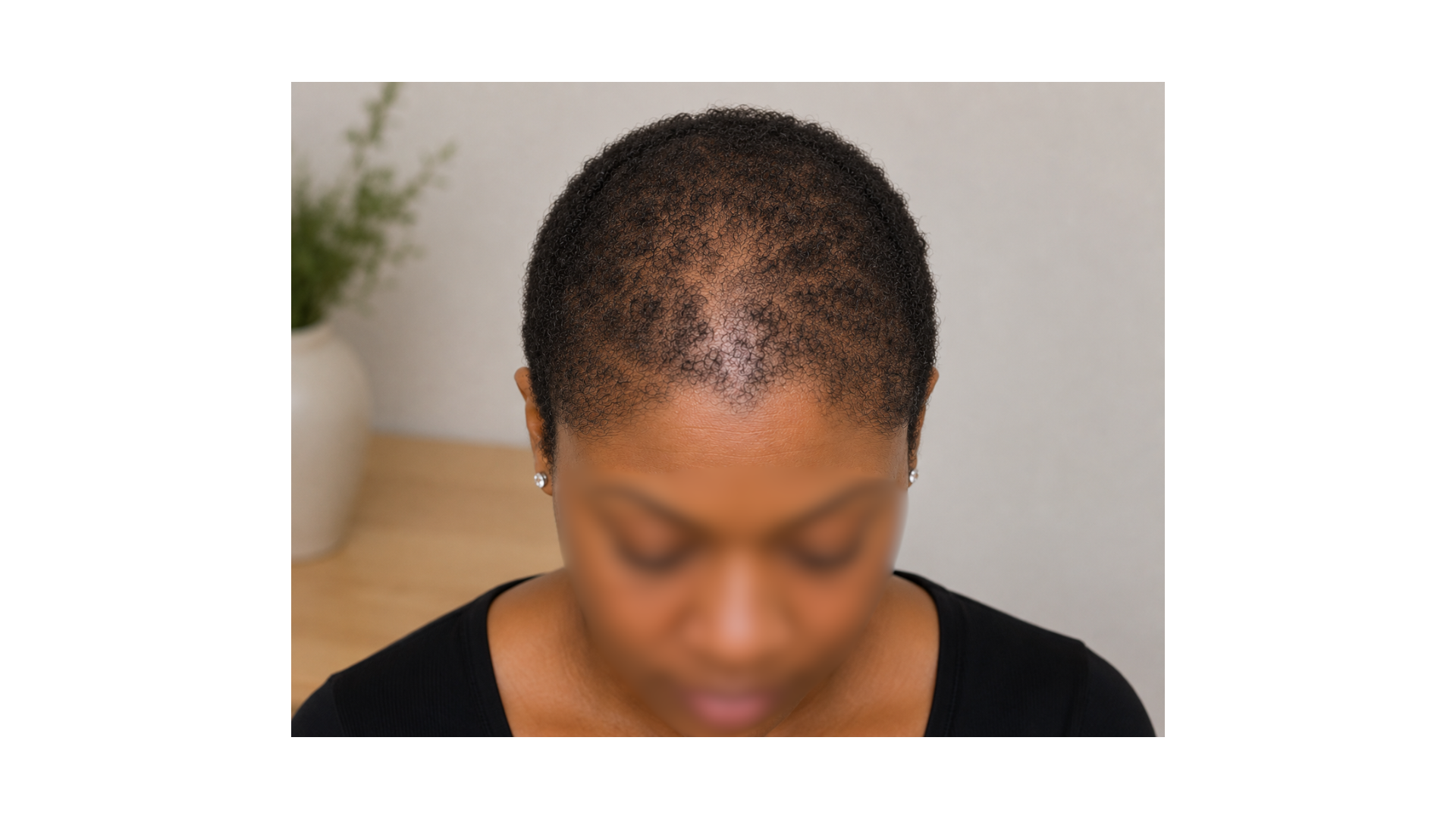 Man after receiving hairline and visual density, with his hairloss treated and his look restored.