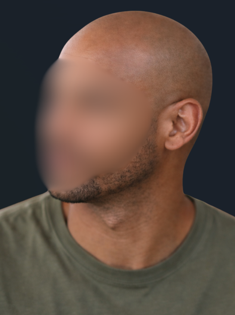 Man after receiving hairline and visual density, with his hairloss treated and his look restored.