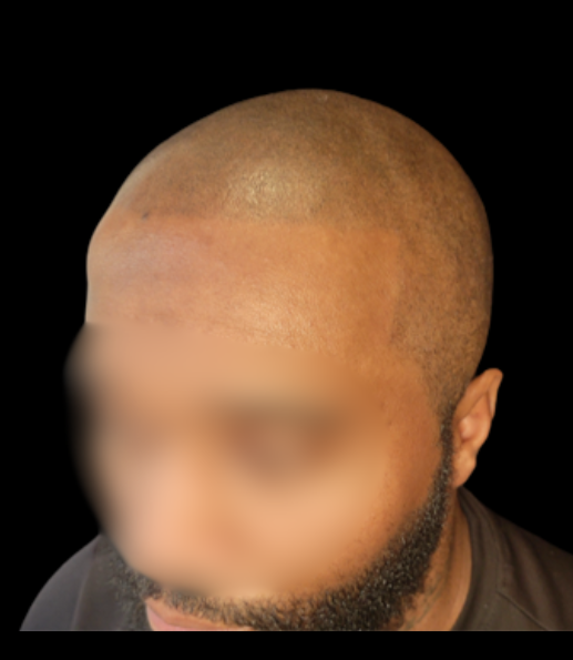 Before treatment result example 1