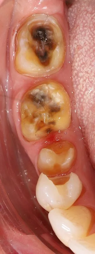 Step 3: Decay removed