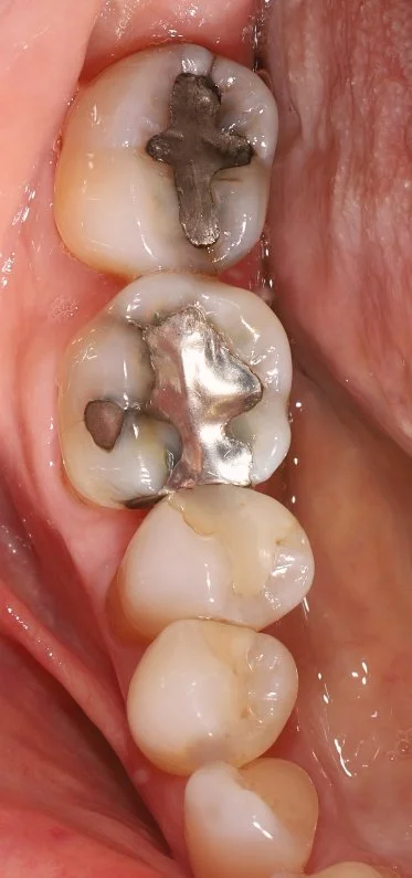 Step 1: Old fillings with decay