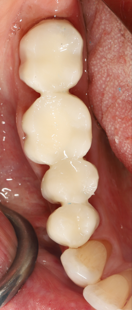 Step 6: Provisionals