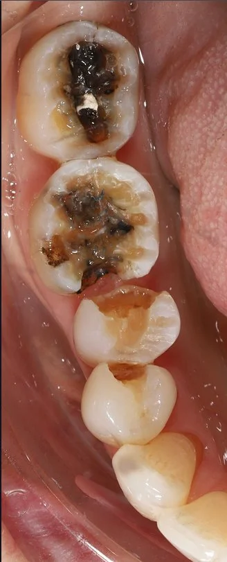 Step 2: Old dentistry removed