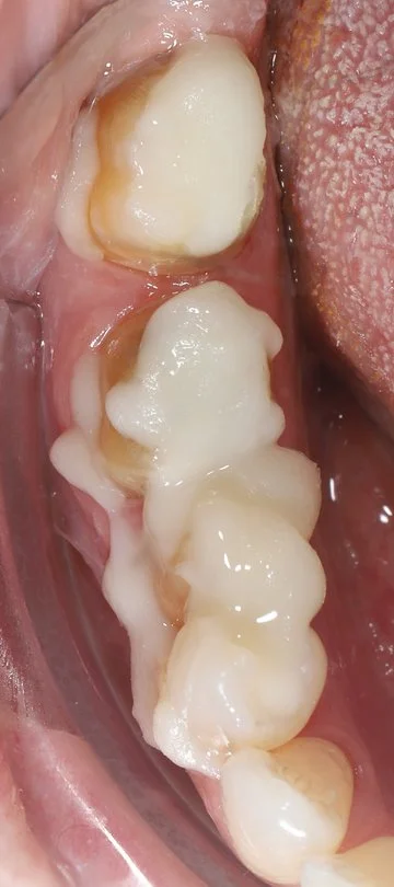 Step 4: Core buildups