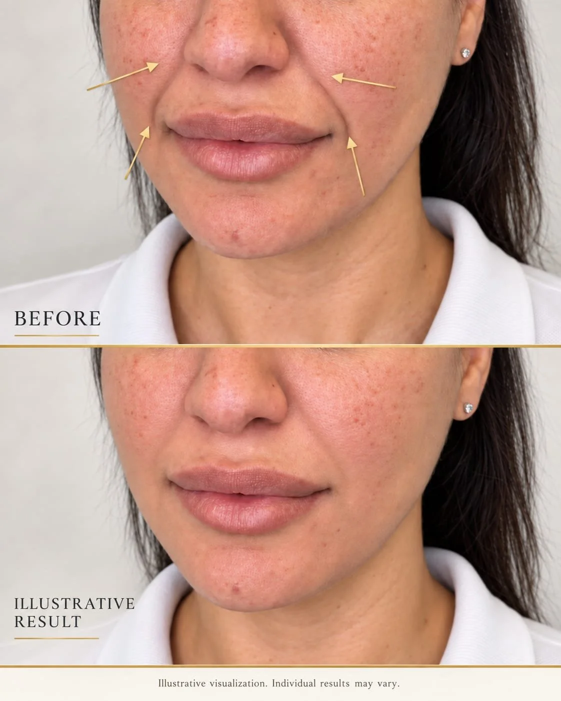 Nasolabial fold filler treatment at By Bautis Spa in Round Rock, TX