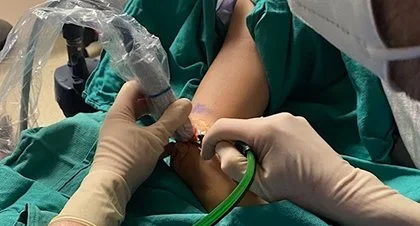 ACL and Meniscus Repair Nashville