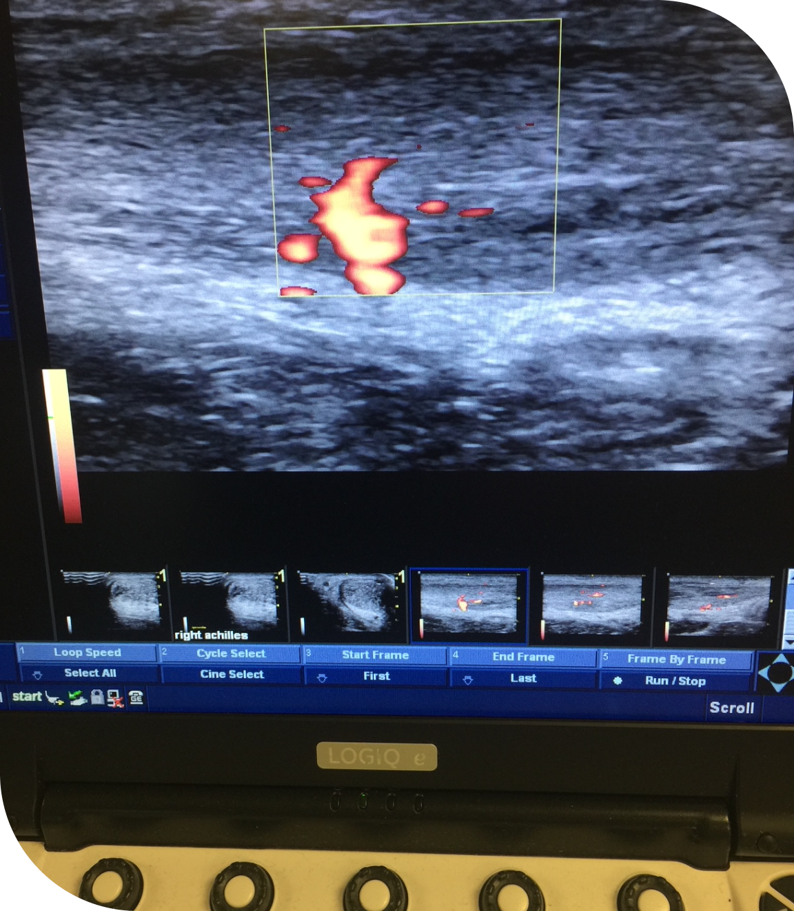 MSK Ultrasound vs. MRI: What's the Better First Step?