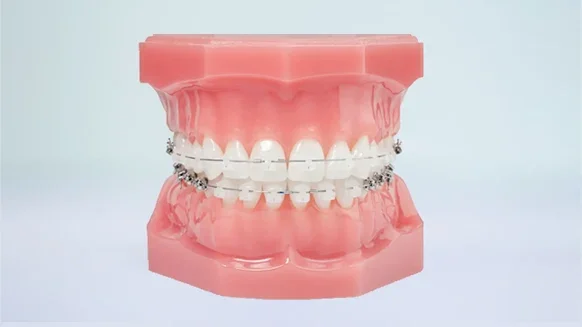 Clear ceramic braces for discreet orthodontic treatment at Weiler Orthodontics Harrisonburg VA
