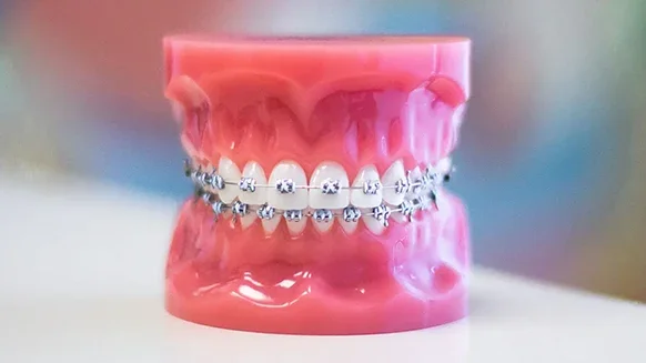 Traditional metal braces with advanced bracket technology at Weiler Orthodontics Harrisonburg VA