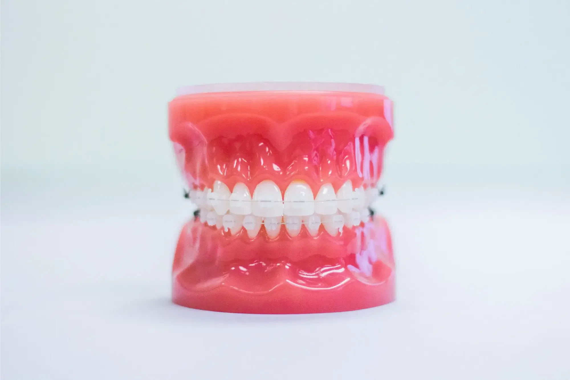 Ceramic braces