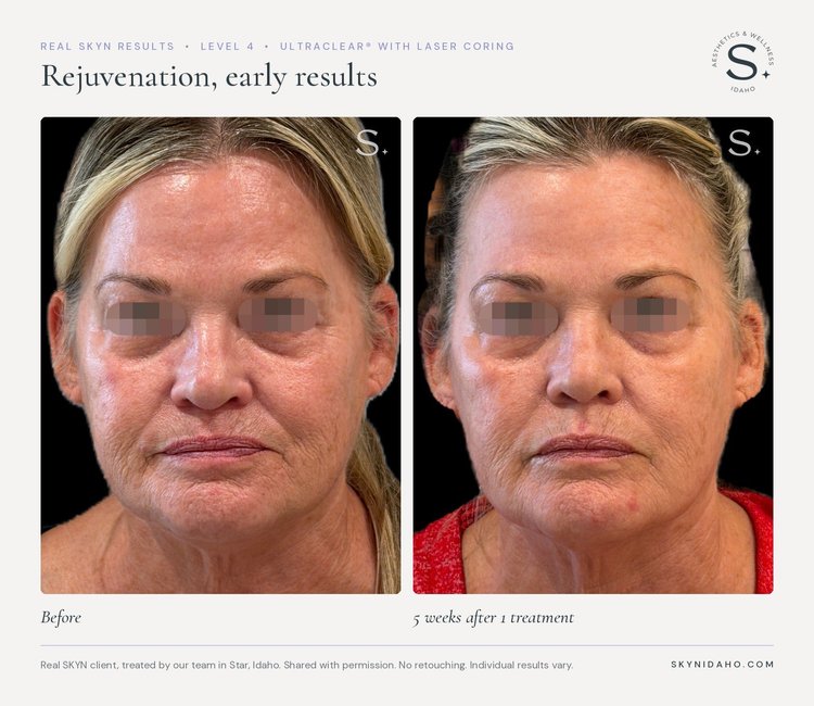 Before and after, Rejuvenation, early results, 5 weeks after 1 treatment, Level 4 · UltraClear® + Laser Coring