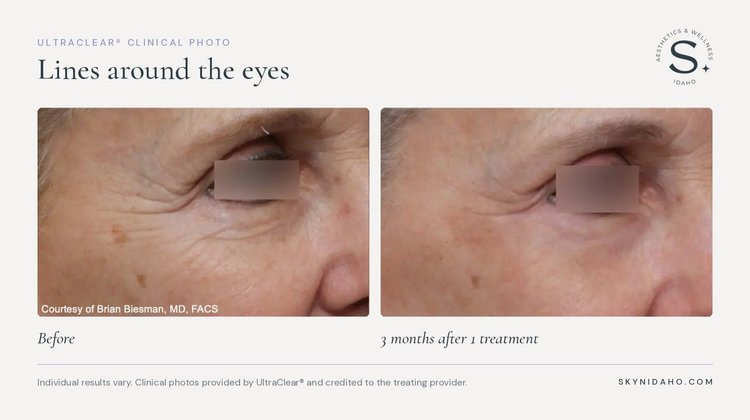 Before and after, Lines around the eyes, 3 months after 1 treatment