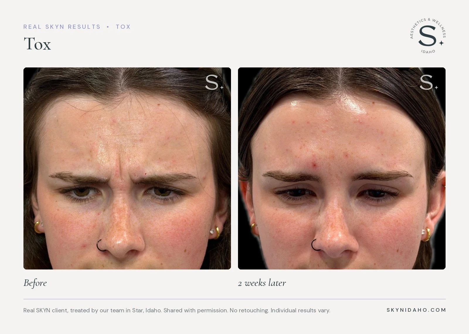 Before and after, Tox, frown lines, 2 weeks later, at SKYN in Star, Idaho