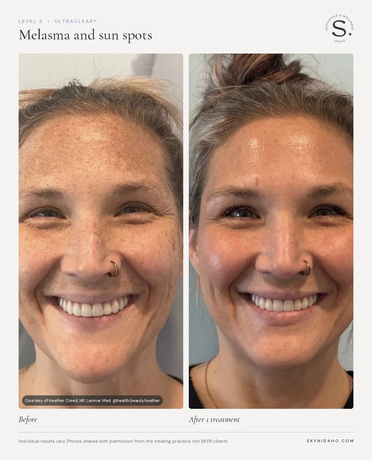 Before and after, Melasma and sun spots, After 1 treatment, Level 3 · UltraClear®