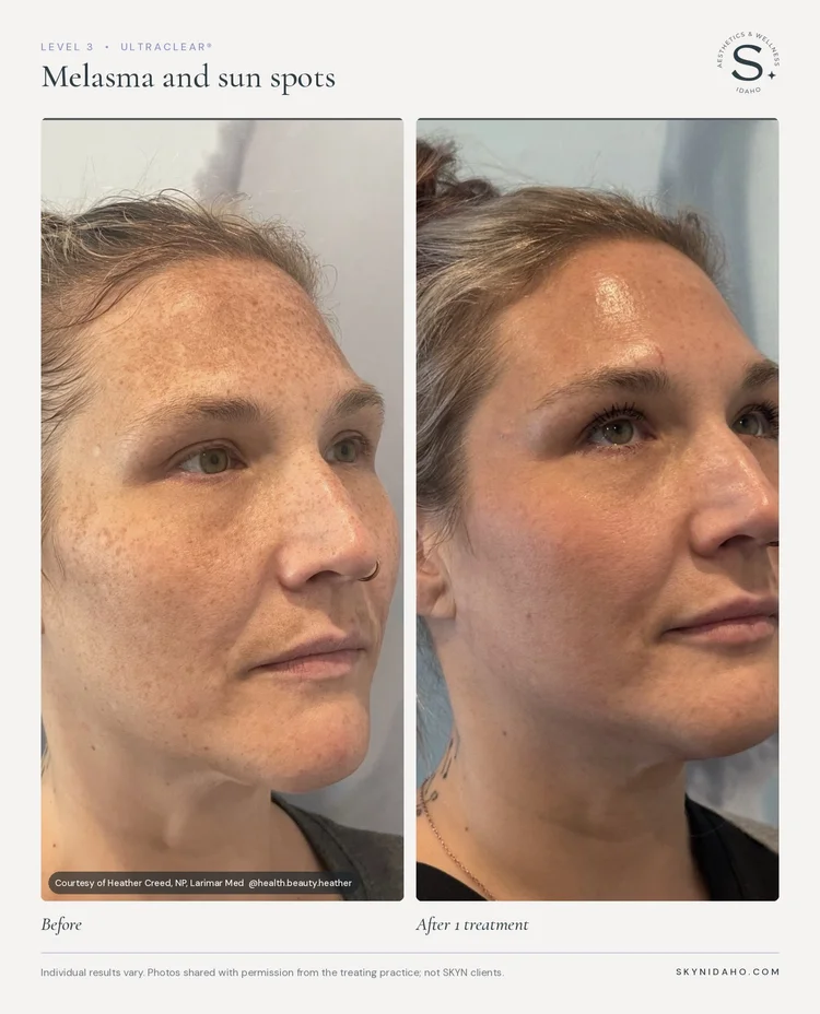 Before and after, Melasma and sun spots, After 1 treatment, Level 3 · UltraClear®