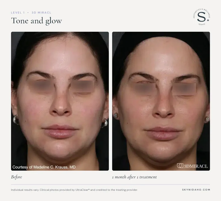 Before and after, Tone and glow, 1 month after 1 treatment, Level 1 · 3D MIRACL