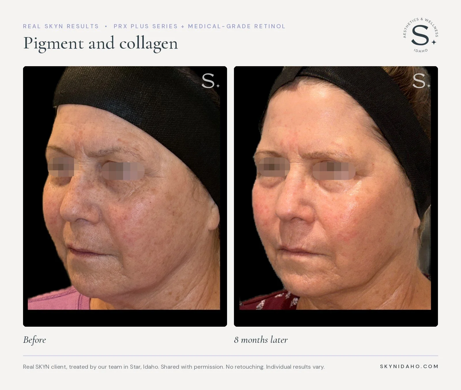 Before and after, Pigment and collagen, 8 months later, at SKYN in Star, Idaho