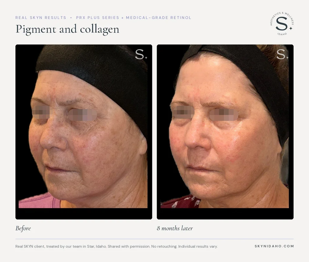Before and after, Pigment and collagen, 8 months later