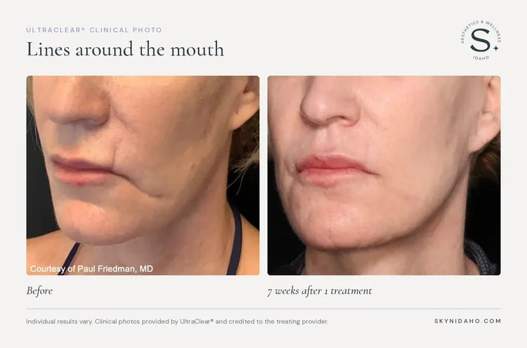 Before and after, Lines around the mouth, 7 weeks after 1 treatment