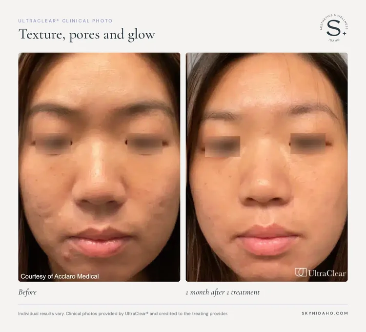 Before and after, Texture, pores and glow, 1 month after 1 treatment