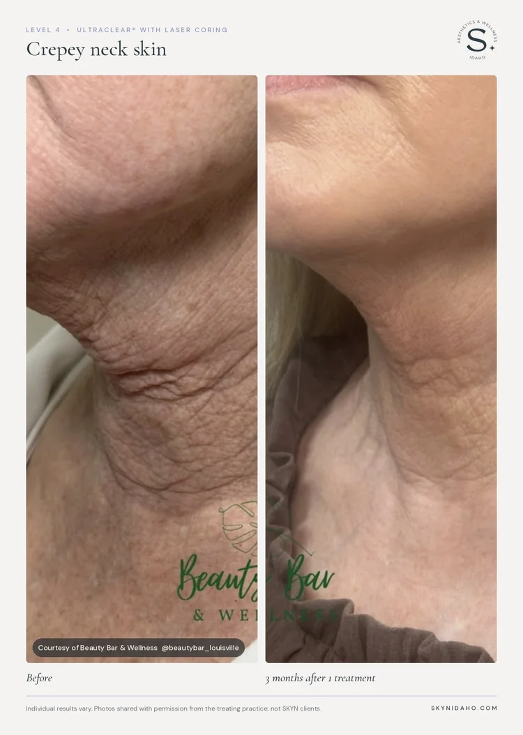 Before and after, Crepey neck skin, 3 months after 1 treatment, Level 4 · UltraClear® + Laser Coring